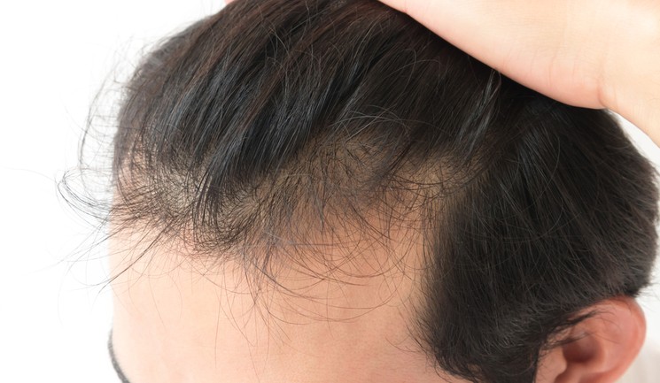 Affordable Nido hair implant, Biofibre, Synthetic Hair Transplant in India  — Teletype